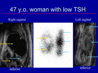 47 y.o. woman with low TSH
Right sagittal         Left sagittal




 inferior                 inferior
 