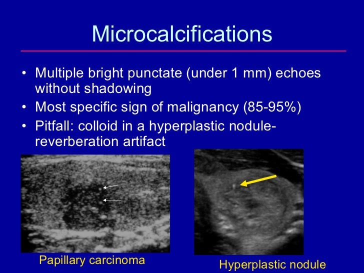 The Epidemic Of Thyroid Nodules Which Should Undergo Fine Needle Asp