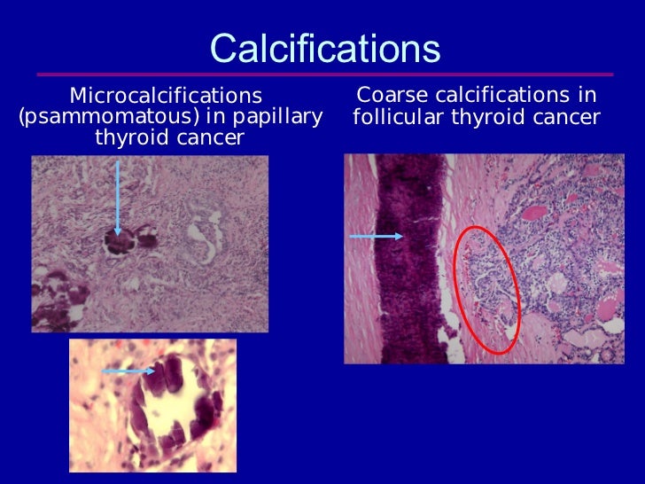 Colloid thyroid nodule with calcium