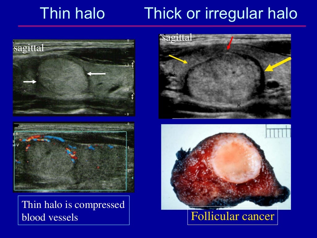 The Epidemic of Thyroid Nodules Which Should Undergo Fine Needle Asp…