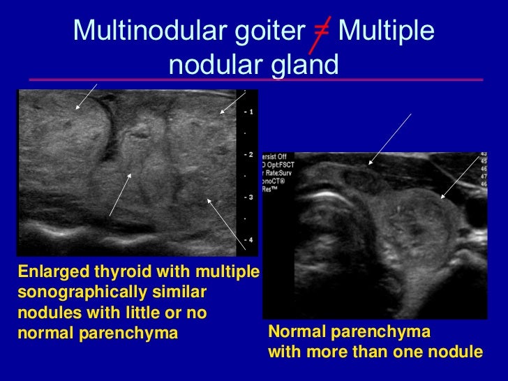 Multi goiter thyroid