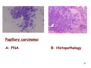 Papillary carcinoma :  A: FNA B: Histopathology 