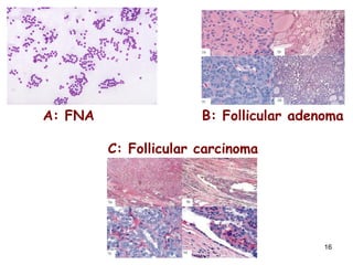 A: FNA    B: Follicular adenoma   C: Follicular carcinoma 