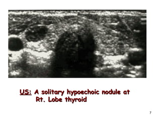 US:  A solitary hypoechoic nodule at Rt. Lobe thyroid Slide 12 Slide 12 
