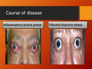 Course of disease
Inflammatory/active phase
• red and painful
• one to two years (range 6
months to 5 years).
• Active inflammation recurs
in about 1% of patients
after months to years of
inactivity
Fibrotic/inactive phase
• permanent structural
changes.
• no reliable test or sign.
• Stable clinical findings for
6 months suggest that the
patient has passed from
the active to the inactive
phase.
 