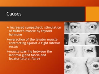 Causes
 increased sympathetic stimulation
of Müller’s muscle by thyroid
hormone
overaction of the levator muscle
contracting against a tight inferior
rectus
muscle scarring between the
lacrimal gland fascia and
levator(lateral flare)
 