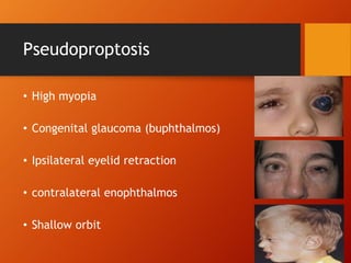 Pseudoproptosis
• High myopia
• Congenital glaucoma (buphthalmos)
• Ipsilateral eyelid retraction
• contralateral enophthalmos
• Shallow orbit
 