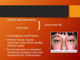 • Thyroid ophthalmopathy
+
exotropia
• Convergence insufficiency
• Inferior rectus muscle
restriction may mimic double
elevator palsy
• Forced ductions or elevated
intraocular pressure with eye
movement for confirmation.
} Concurrent MG
 