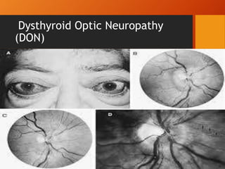 Dysthyroid Optic Neuropathy
(DON)
• Pressure from enlarged muscles on the optic nerve or
the vessels that supply it.
• This occurs when the enlarged EOM expand to
compress the optic nerve instead of producing
exophthalmos.
• Gradual decline in visual acuity, color vision
disturbance, development of an afferent pupillary
defect and central or paracentral scotomas
• Bilateral, simultaneous optic neuropathy can occur
which would eliminate a relative afferent pupillary
defect
McKeag D, Lane C, Lazarus JH, Baldeschi L, Boboridis K, Dickinson AJ, Hullo AI, Kahaly G, Krassas G, Marcocci C, Marinò M, Mourits MP, Nardi M, Neoh C,
Orgiazzi J, Perros P, Pinchera A, Pitz S, Prummel MF, Sartini MS, Wiersinga WM; European Group on Graves’ Orbitopathy (EUGOGO). Clinical features of
dysthyroid optic neuropathy: a European Group on Graves’Orbitopathy (EUGOGO) survey. Br J Ophthalmol. 2007;91:455-458.
 