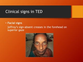 Clinical signs in TED
• Facial signs
joffroy’s sign-absent creases in the forehead on
superior gaze
 