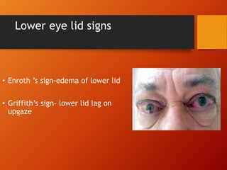 Lower eye lid signs
• Enroth ’s sign-edema of lower lid
• Griffith’s sign- lower lid lag on
upgaze
 