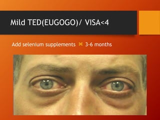 Mild TED(EUGOGO)/ VISA<4
Add selenium supplements 3-6 months
 