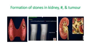 Formation of stones in kidney, #, & tumour
 