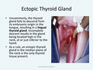Ectopic Thyroid Gland
• Uncommonly, the thyroid
gland fails to descend from
its embryonic origin in the
tongue, resulting in a lingual
thyroid gland. Incomplete
descent results in the gland
being located high in the
neck, at or just inferior to the
hyoid.
• As a rule, an ectopic thyroid
gland in the median plane of
the neck is the only thyroid
tissue present.
DR NDAYISABA CORNEILLE
 