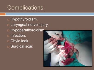 Complications
 Hypothyroidism.
 Laryngeal nerve injury.
 Hypoparathyroidism.
 Infection.
 Chyle leak.
 Surgical scar.
 