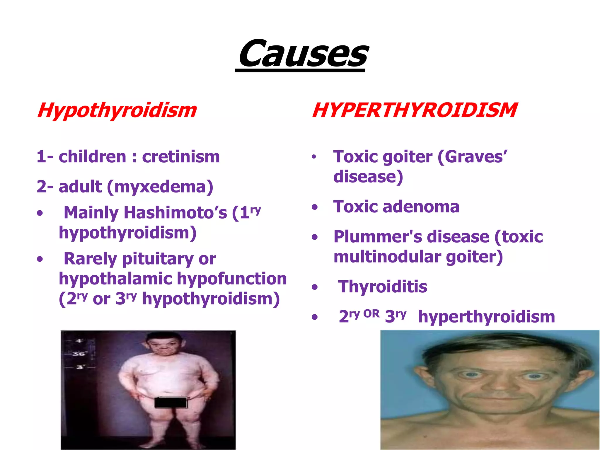 Causes
Hypothyroidism
1- children : cretinism
2- adult (myxedema)
• Mainly Hashimoto’s (1ry
hypothyroidism)
• Rarely pituitary or
hypothalamic hypofunction
(2ry or 3ry hypothyroidism)
HYPERTHYROIDISM
• Toxic goiter (Graves’
disease)
• Toxic adenoma
• Plummer's disease (toxic
multinodular goiter)
• Thyroiditis
• 2ry OR 3ry hyperthyroidism
 