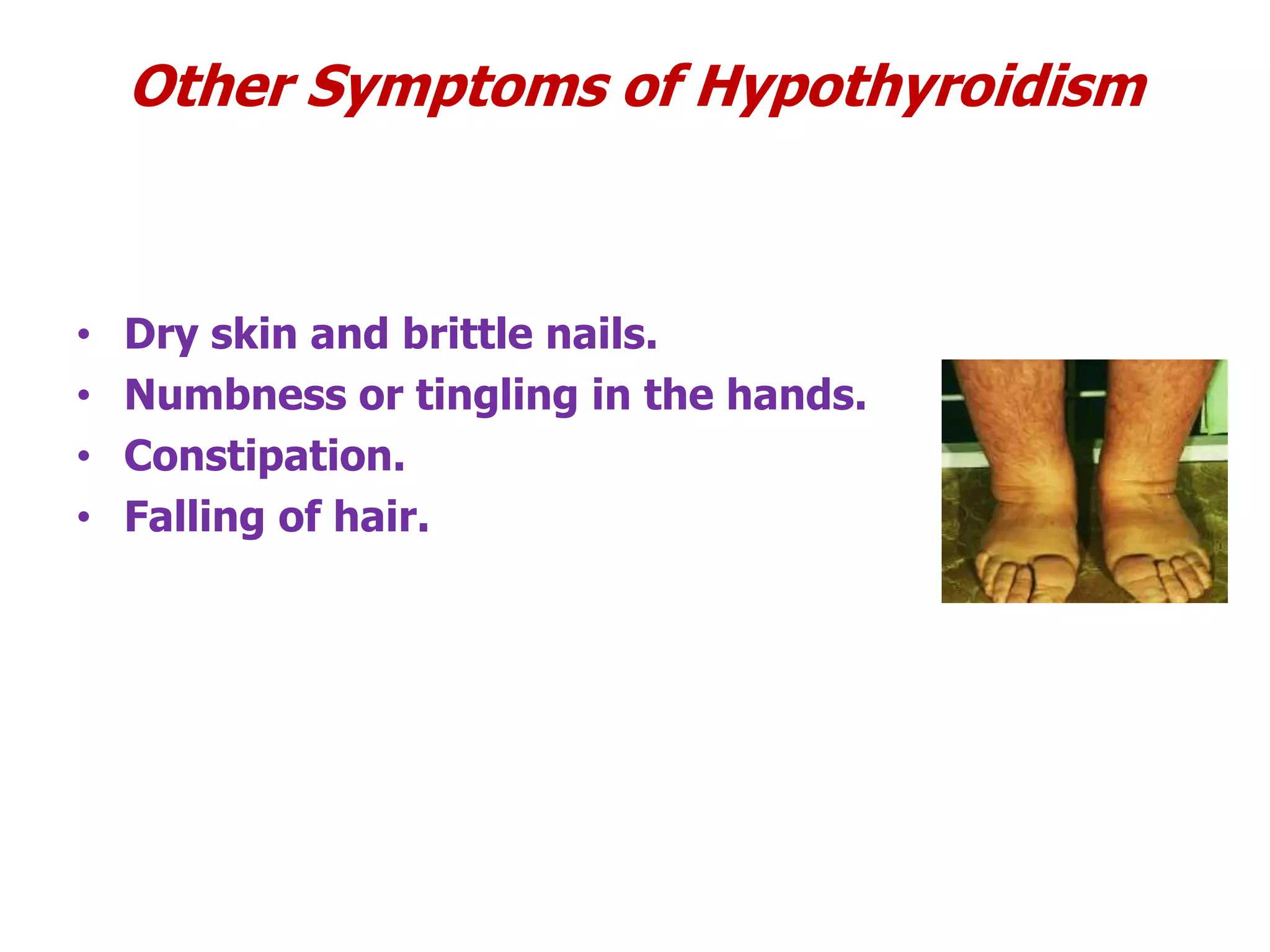 Other Symptoms of Hypothyroidism
• Dry skin and brittle nails.
• Numbness or tingling in the hands.
• Constipation.
• Falling of hair.
 