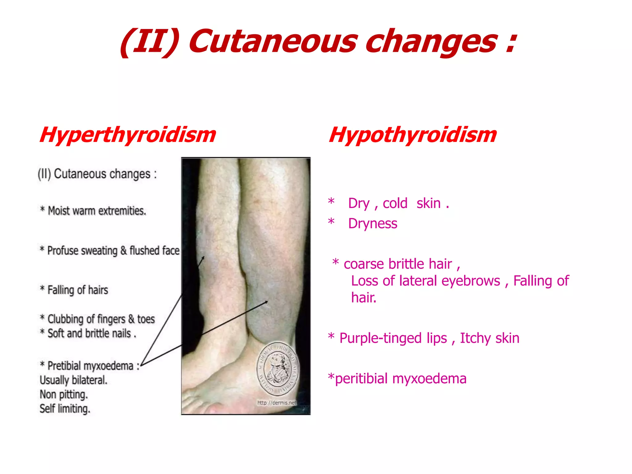 (II) Cutaneous changes :
Hypothyroidism
* Dry , cold skin .
* Dryness
* coarse brittle hair ,
Loss of lateral eyebrows , Falling of
hair.
* Purple-tinged lips , Itchy skin
*peritibial myxoedema
Hyperthyroidism
 