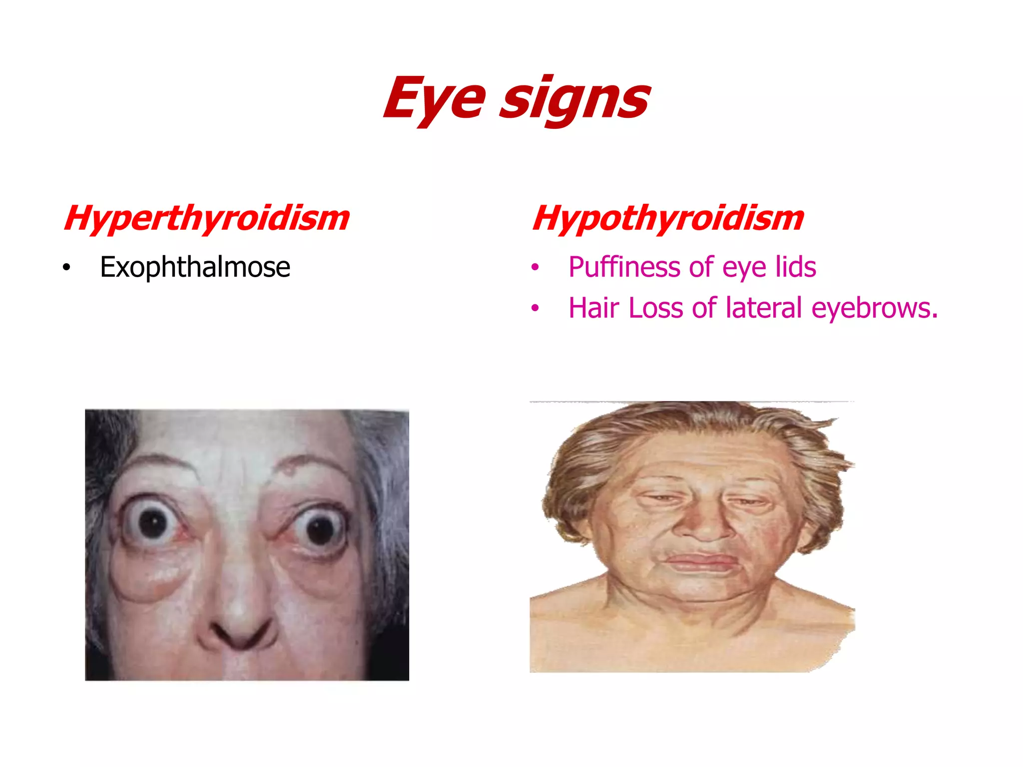 Eye signs
Hyperthyroidism
• Exophthalmose
Hypothyroidism
• Puffiness of eye lids
• Hair Loss of lateral eyebrows.
 