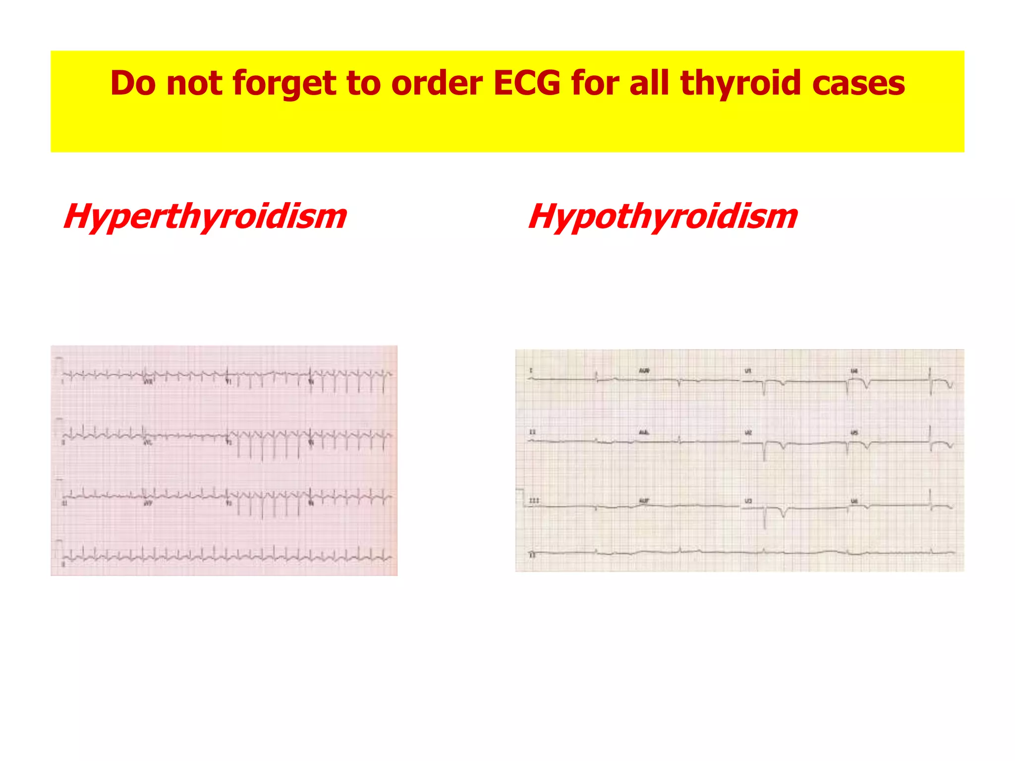 Do not forget to order ECG for all thyroid cases
Hyperthyroidism Hypothyroidism
 