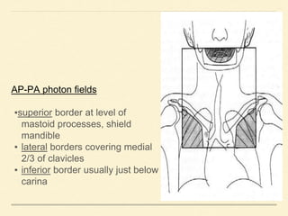AP-PA photon fields
▪superior border at level of
mastoid processes, shield
mandible
▪ lateral borders covering medial
2/3 of clavicles
▪ inferior border usually just below
carina
 