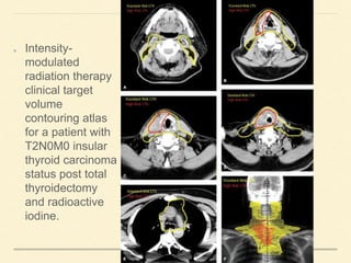 Intensity-
modulated
radiation therapy
clinical target
volume
contouring atlas
for a patient with
T2N0M0 insular
thyroid carcinoma
status post total
thyroidectomy
and radioactive
iodine.
 