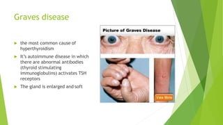 Graves disease
 the most common cause of
hyperthyroidism
 It’s autoimmune disease in which
there are abnormal antibodies
(thyroid stimulating
immunoglobulins) activates TSH
receptors
 The gland is enlarged and soft
 