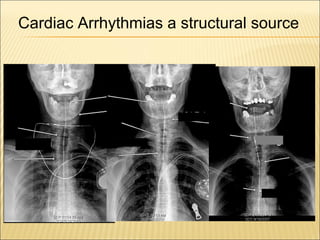 Cardiac Arrhythmias a structural source
 