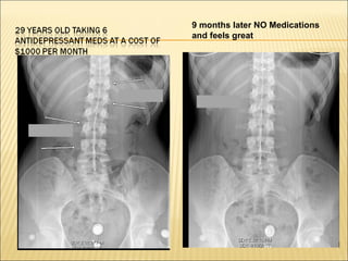 9 months later NO Medications
and feels great
 