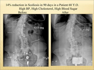 14% reduction in Scoliosis in 90 days in a Patient 68 Y.O.
High BP, High Cholesterol, High Blood Sugar
Before After
 