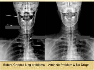 Thyroid stress and inflammation