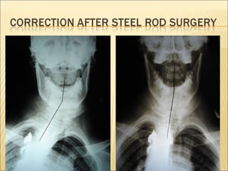Thyroid stress and inflammation