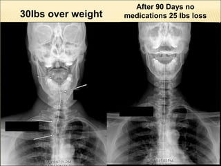 Thyroid stress and inflammation