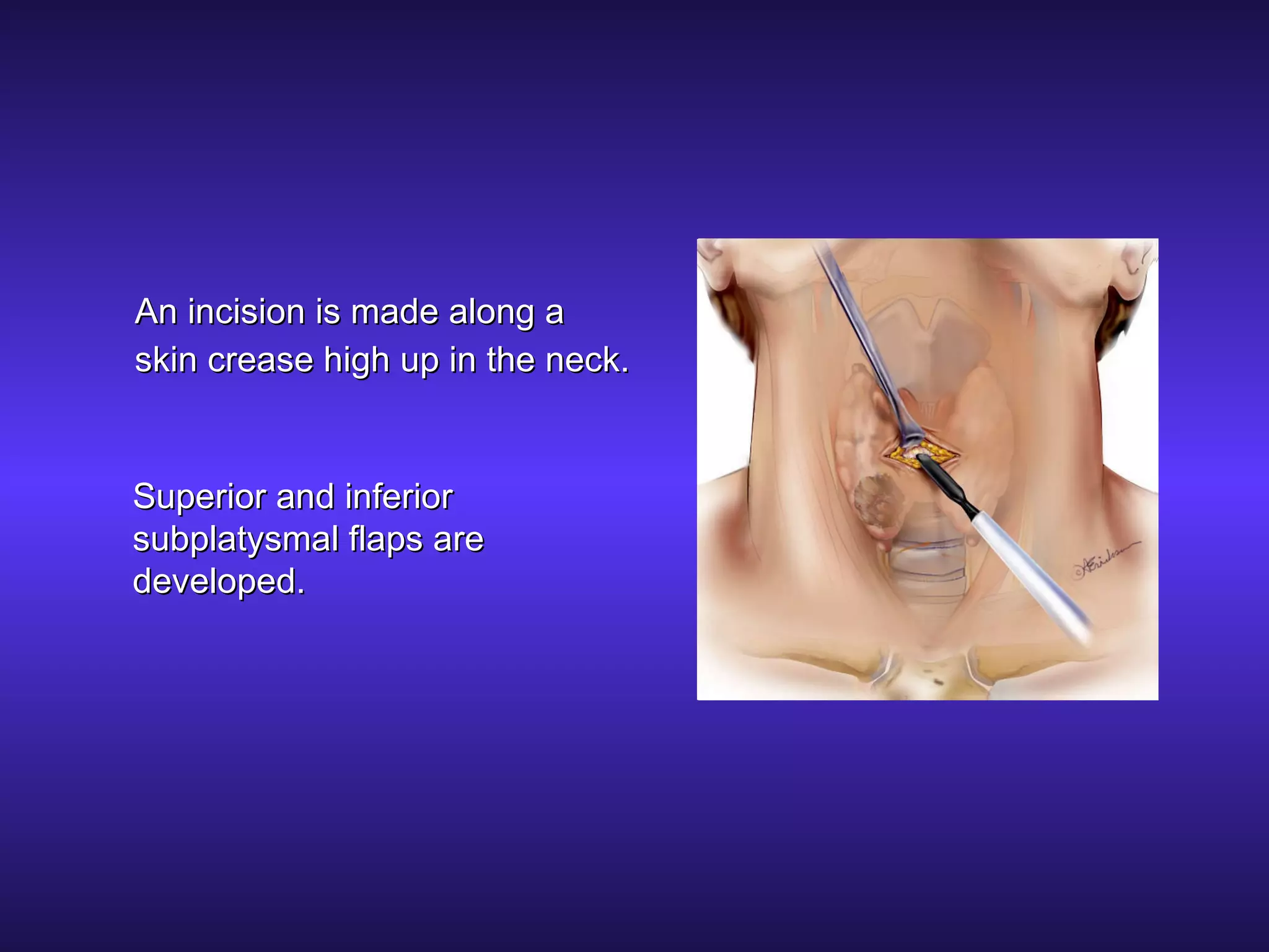 Lahey Incision Thyroid Surgery by Mini-incision | PPT