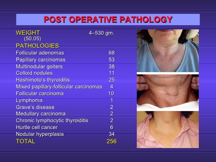 Thyroid Surgery by Miniincision