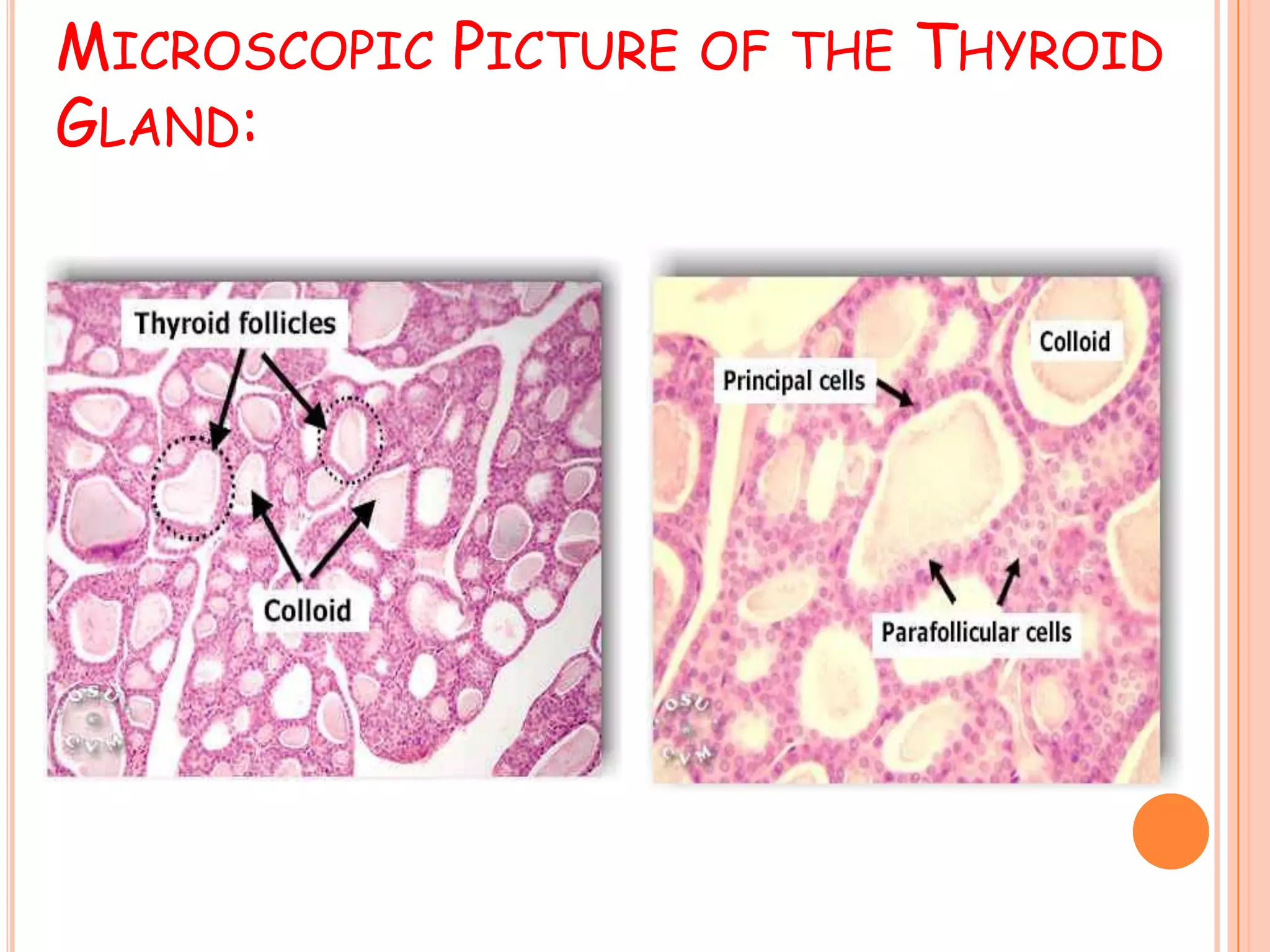 Thyroid Tumor