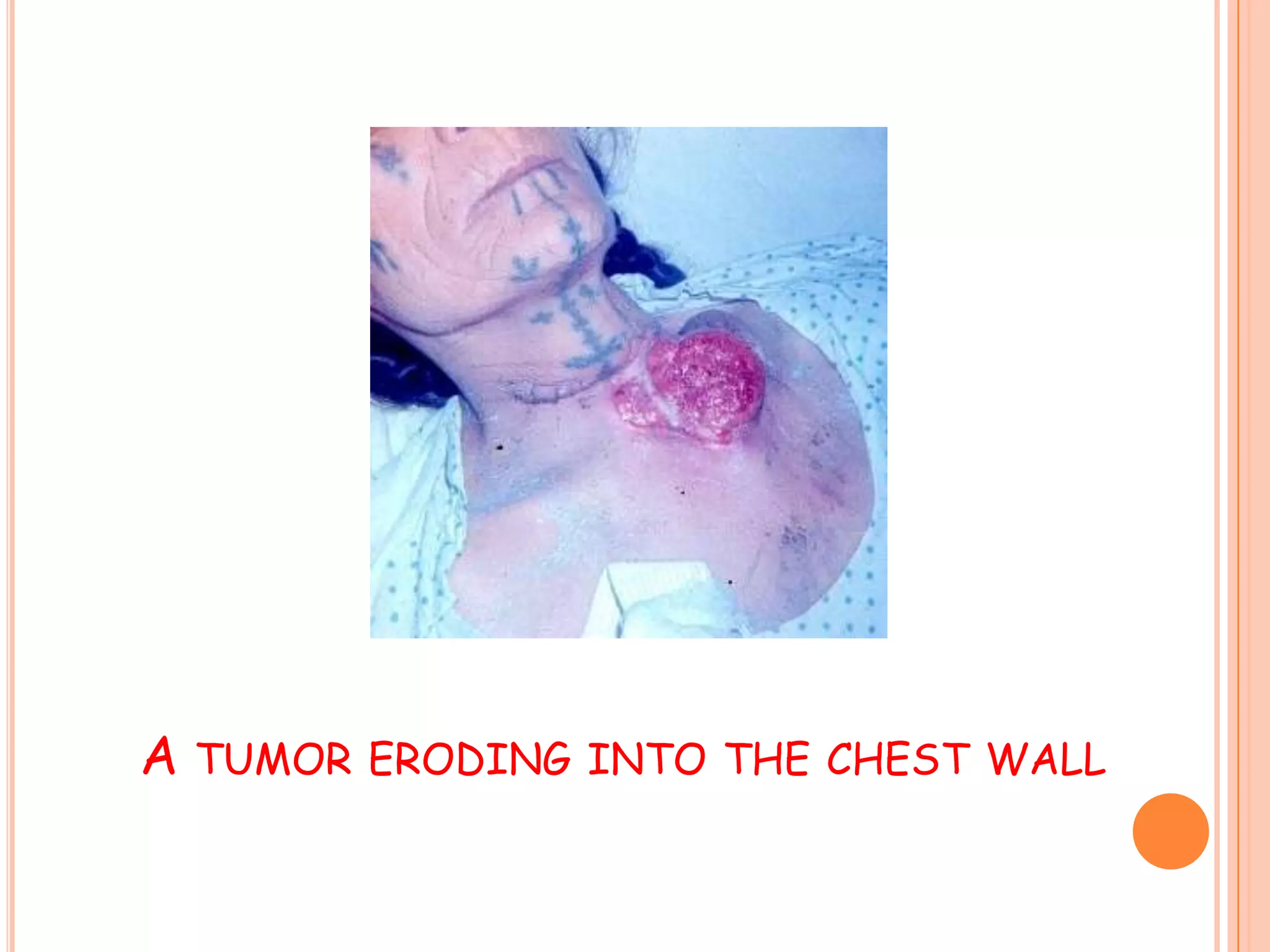 Thyroid Tumor