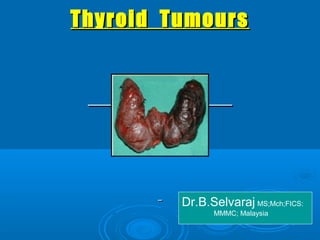 TThhyyrrooiidd TTuummoouurrss 
Dr.B.Selvaraj MS;Mch;FICS: 
MMMC; Malaysia 
 