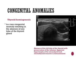 CONGENITAL ANOMALIES
Thyroid hemiagenesis
 is a rare congenital
anomaly resulting in
the absence of one
lobe of the thyroid
gland
Absence of the left lobe of the thyroid with
preservation of the isthmus. Apparent
hypertrophy of the sternohyoid and
sternothyroid muscles is demonstrated
 