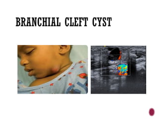 BRANCHIAL CLEFT CYST
 
