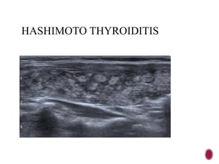 HASHIMOTO THYROIDITIS
 
