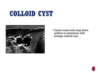 COLLOID CYST
 Cystic mass with ring down
artifact is consistent with
benign colloid cyst
 