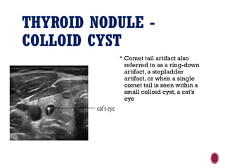 THYROID NODULE -
COLLOID CYST
 Comet tail artifact also
referred to as a ring-down
artifact, a stepladder
artifact, or when a single
comet tail is seen within a
small colloid cyst, a cat’s
eye
 