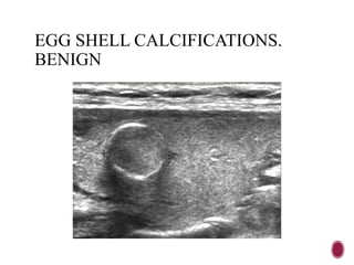 EGG SHELL CALCIFICATIONS.
BENIGN
 