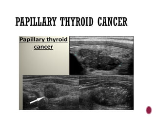 PAPILLARY THYROID CANCER
 