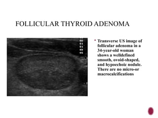 FOLLICULAR THYROID ADENOMA
 Transverse US image of
follicular adenoma in a
34-year-old woman
shows a welldefined
smooth, ovoid-shaped,
and hypoechoic nodule.
There are no micro-or
macrocalcifications
 