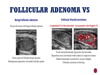 FOLLICULAR ADENOMA VS
FOLLICULAR CARCINOMA
 