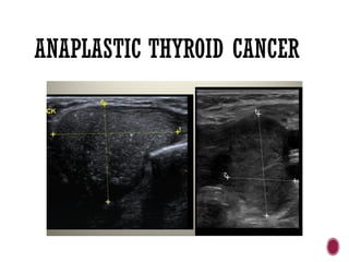ANAPLASTIC THYROID CANCER
 