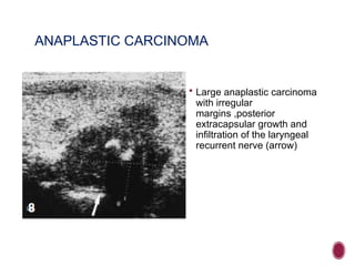 ANAPLASTIC CARCINOMA
 Large anaplastic carcinoma
with irregular
margins ,posterior
extracapsular growth and
infiltration of the laryngeal
recurrent nerve (arrow)
 