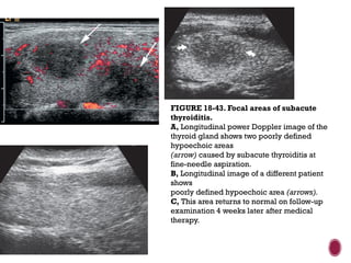 FIGURE 18-43. Focal areas of subacute
thyroiditis.
A, Longitudinal power Doppler image of the
thyroid gland shows two poorly defined
hypoechoic areas
(arrow) caused by subacute thyroiditis at
fine-needle aspiration.
B, Longitudinal image of a different patient
shows
poorly defined hypoechoic area (arrows).
C, This area returns to normal on follow-up
examination 4 weeks later after medical
therapy.
 